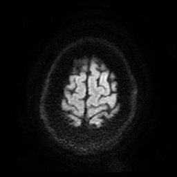 Cerebral cavernous venous malformation (Zabramski type II) (Radiopaedia 85511-101198 Axial DWI 61).jpg