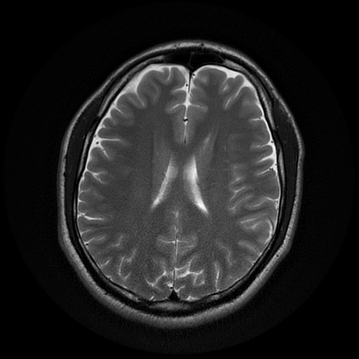 File:Cerebral cavernous venous malformation (Zabramski type II) (Radiopaedia 85511-101198 Axial T2 20).jpg