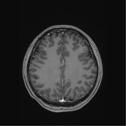 Cerebral cavernous venous malformations (Radiopaedia 48117-52946 Axial T1 C+ 42).png