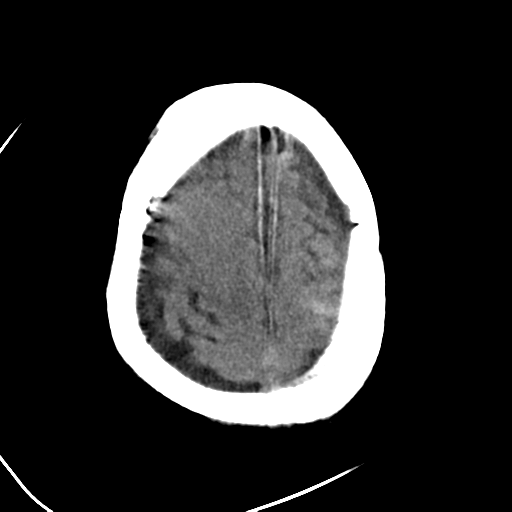 File:Cerebral contusions, subarachnoid hemorrhage and subdural hygromas (Radiopaedia 55399-61830 Axial non-contrast 25).png