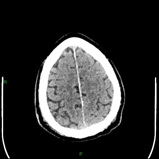 Cerebral contusions (Radiopaedia 33868-35039 Axial non-contrast 182).jpg