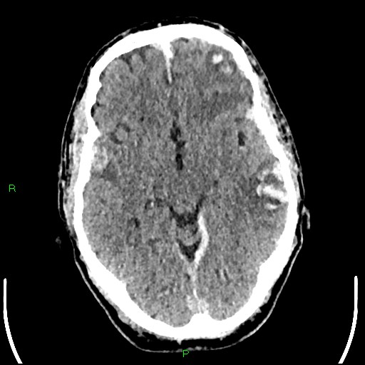 Cerebral contusions (Radiopaedia 33868-35039 Axial non-contrast 89).jpg