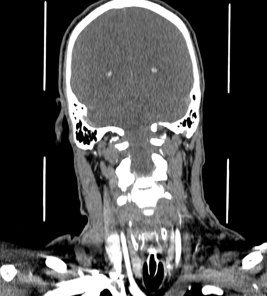 Cerebral edema in an overdose patient (Radiopaedia 72005-82539 B 107).jpg