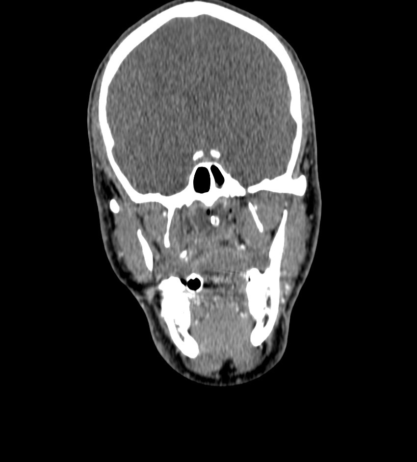 Cerebral edema in an overdose patient (Radiopaedia 72005-82539 B 12).jpg