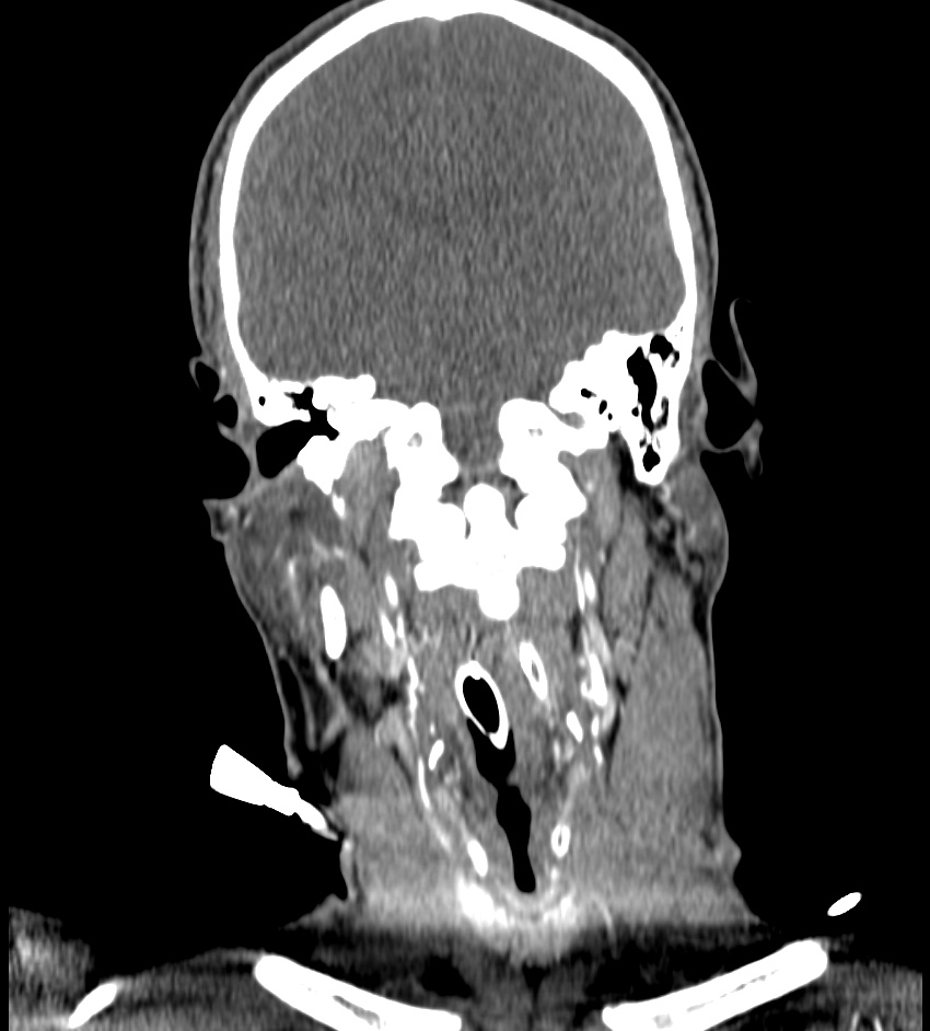 Cerebral edema in an overdose patient (Radiopaedia 72005-82539 B 73).jpg