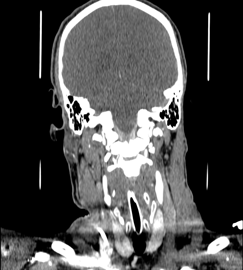 Cerebral edema in an overdose patient (Radiopaedia 72005-82539 B 91).jpg