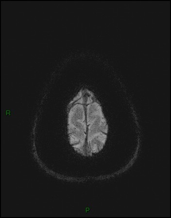 File:Cerebral fat embolism (Radiopaedia 35022-36525 Axial SWI 65).jpg
