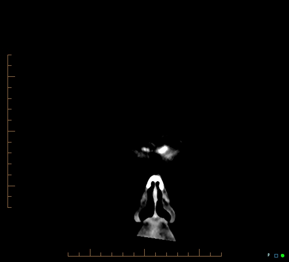 Cerebral fat embolism (Radiopaedia 85521-101220 Coronal non-contrast 2).jpg