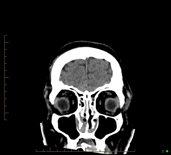 Cerebral fat embolism (Radiopaedia 85521-101224 Coronal non-contrast 11).jpg