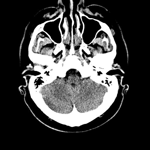 File:Cerebral hemorrhagic contusions and cervical spine fractures (Radiopaedia 32865-33841 Axial non-contrast 7).jpg