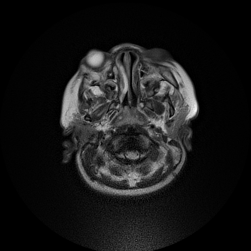 File:Cerebral manifestations of mucopolysaccharidosis type I (Radiopaedia 59171-66487 Axial T2 1).jpg