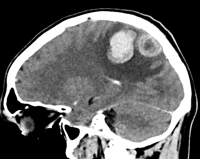 Cerebral metastases - testicular choriocarcinoma (Radiopaedia 84486-99855 F 23).jpg