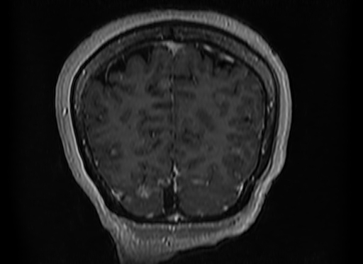 Cerebral metastases from lung cancer with amyloid angiopathy and cerebellopontine angle meningioma (Radiopaedia 74306-85191 Coronal T1 C+ 50).jpg