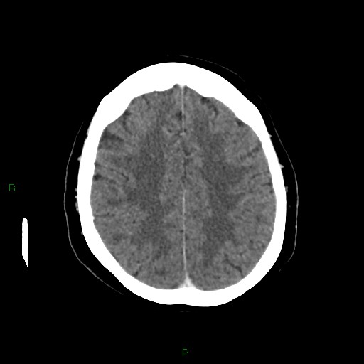File:Cerebral metastasis from renal cell carcinoma (Radiopaedia 82306-96375 Axial C+ delayed 28).jpg