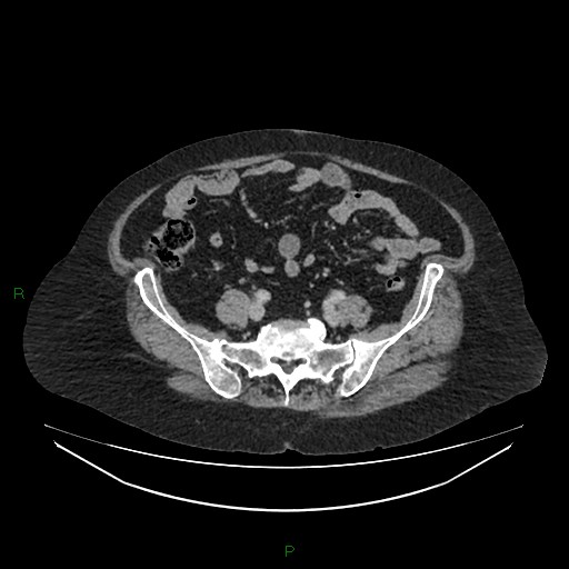 File:Cerebral metastasis from renal cell carcinoma (Radiopaedia 82306-96378 A 133).jpg