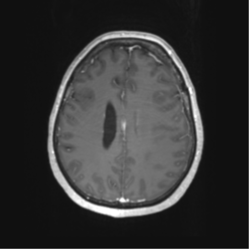Cerebral metastasis mimicking glioblastoma (Radiopaedia 69155-78937 Axial T1 C+ 46).png