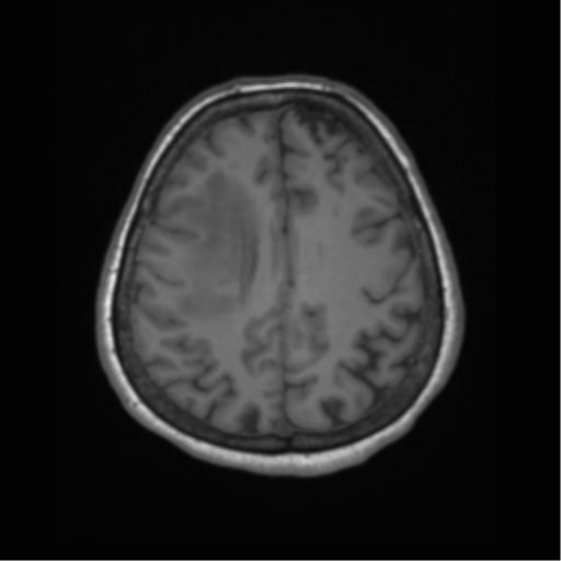 Cerebral metastasis to basal ganglia (Radiopaedia 81568-95413 Axial T1 54).png