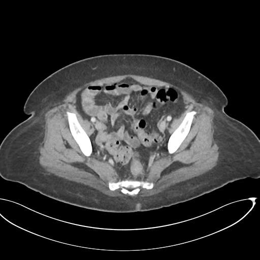 File:Cerebral metastasis to basal ganglia (Radiopaedia 81568-95414 E 64).png