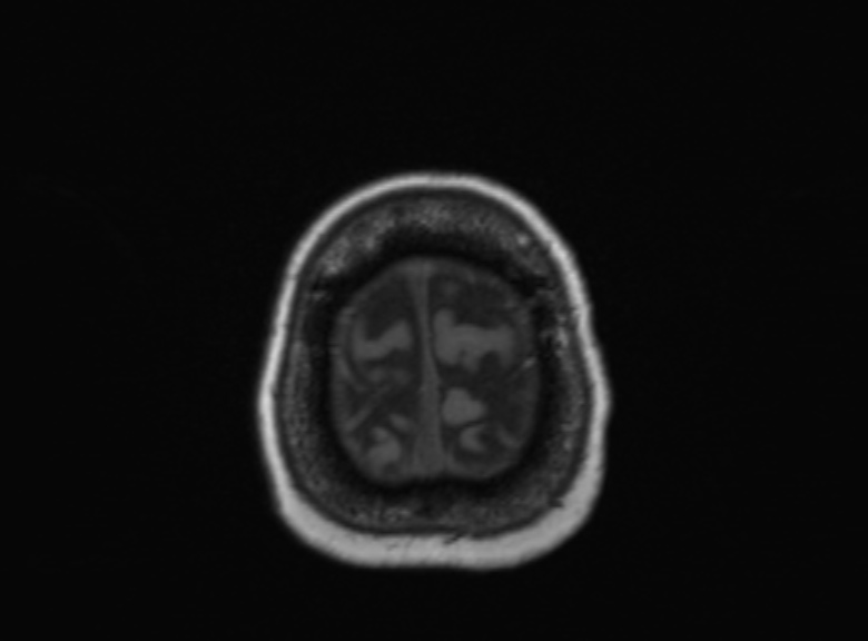 Cerebral ring enhancing lesions - cerebral metastases (Radiopaedia 44922-48817 Axial T1 111).jpg