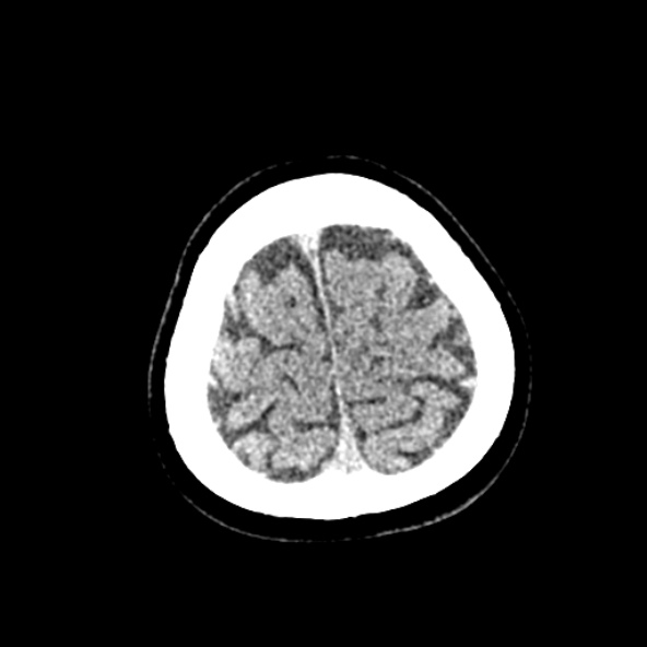 Cerebral ring enhancing lesions - cerebral metastases (Radiopaedia 44922-48818 Axial non-contrast 85).jpg