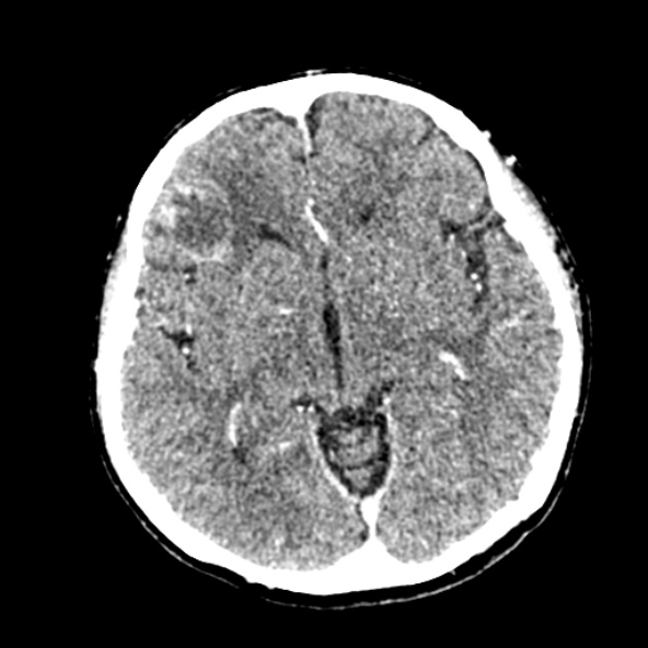 File:Cerebral ring enhancing lesions - cerebral metastases (Radiopaedia 44922-48818 B 134).jpg