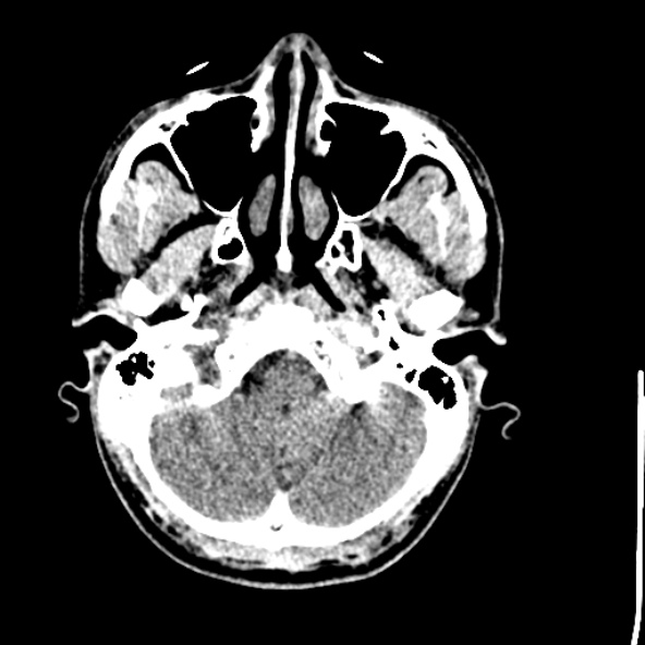 Cerebral toxoplasmosis (Radiopaedia 53993-60131 Axial non-contrast 14).jpg