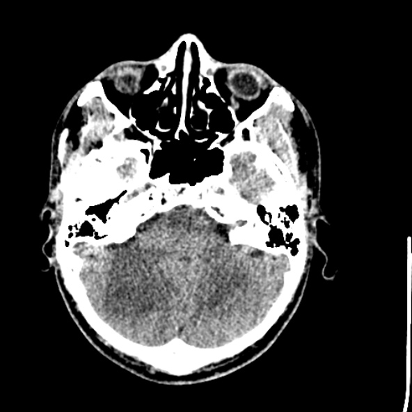 File:Cerebral toxoplasmosis (Radiopaedia 53993-60131 Axial non-contrast 20).jpg