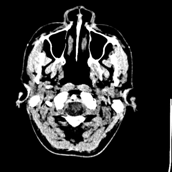 Cerebral toxoplasmosis (Radiopaedia 53993-60131 Axial non-contrast 6).jpg