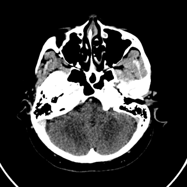 File:Cerebral venous hemorrhagic infarct from venous sinus thrombosis (Radiopaedia 55433-61883 Axial C+ delayed 119).jpg