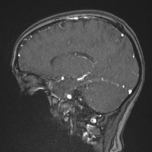 Cerebral venous infarction - hemorrhagic (Radiopaedia 81625-95505 Sagittal MRV 48).jpg