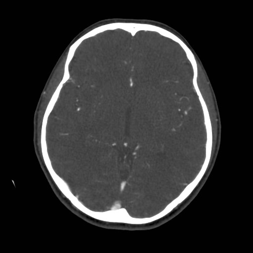 Cerebral venous sinus thrombosis (Radiopaedia 40619-43227 A 108).jpg
