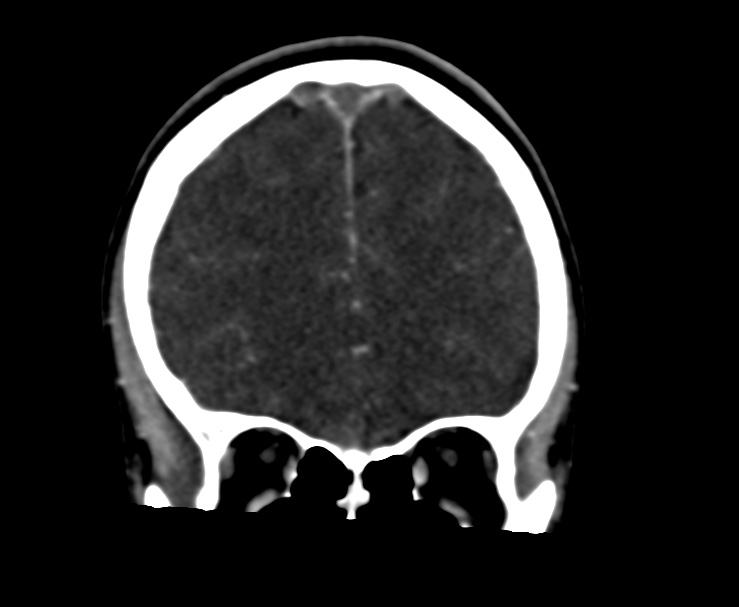 Cerebral venous sinus thrombosis (Radiopaedia 59224-66646 Coronal C+ delayed 18).jpg