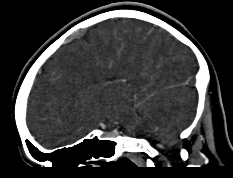 Cerebral venous sinus thrombosis (Radiopaedia 59224-66646 Sagittal C+ delayed 33).jpg