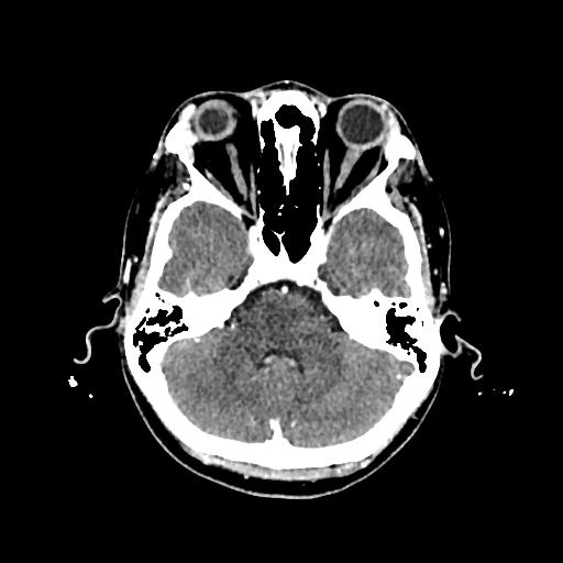 Cerebral venous thrombosis with venous hemorrhagic infarct (Radiopaedia 90354-107660 Axial with contrast 47).jpg