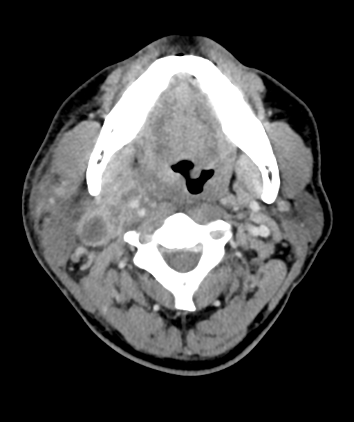 Cervical abscess (Radiopaedia 43725-47184 A 23).png
