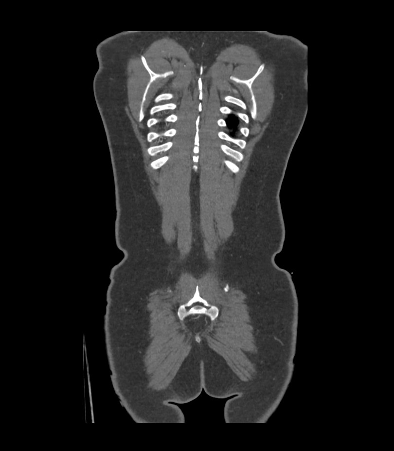 Cervical aortic arch with coarctation and aneurysms (Radiopaedia 44035-47552 C 2).jpg