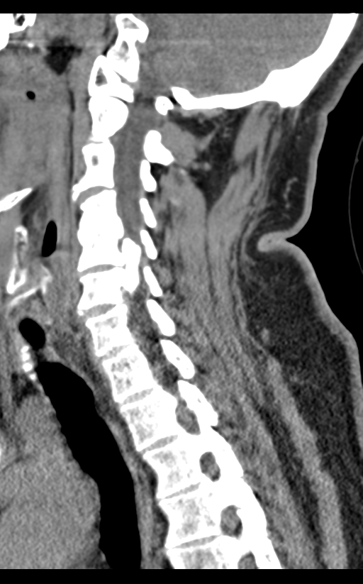 Cervical canal stenosis - OPLL and osteophytes (Radiopaedia 47329-51910 B 47).png