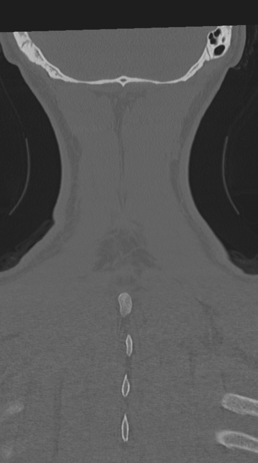 Cervical intercalary bone (Radiopaedia 35211-36748 Coronal bone window 72).png