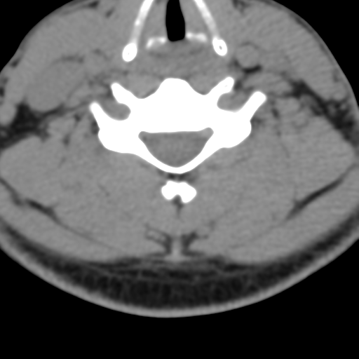 Cervical schwannoma (Radiopaedia 57979-64974 Axial non-contrast 42).png
