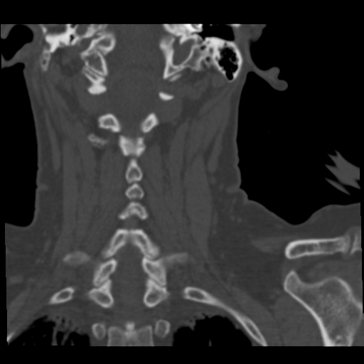 Cervical spine ACDF loosening (Radiopaedia 48998-54070 Sagittal bone window 1).png