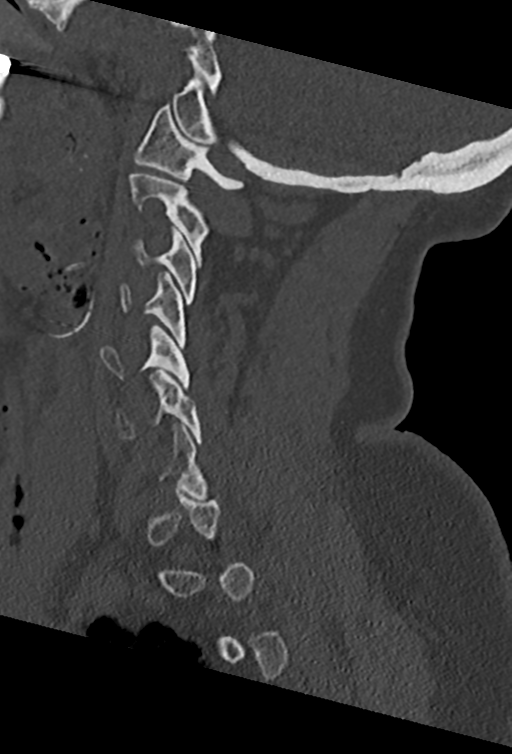 Cervical spine ACDF loosening (Radiopaedia 48998-54070 Sagittal bone window 32).png