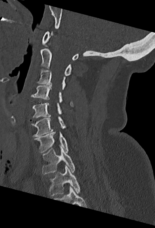 Cervical spine ACDF loosening (Radiopaedia 48998-54070 Sagittal bone window 39).png