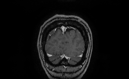 File:Cervical spondylodiscitis and calvarial hemangioma (Radiopaedia 64317-73103 Coronal T1 C+ 69).jpg