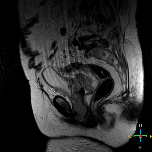 File:Cervical stump squamous cell carcinoma (Radiopaedia 48049-52858 Sagittal T2 7).jpg