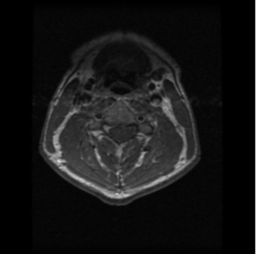 File:Cervical vertebrae metastasis (Radiopaedia 78814-91667 Axial T1 C+ 13).png