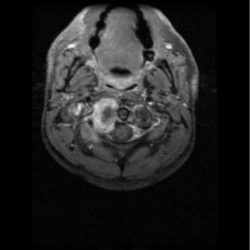 File:Cervical vertebrae metastasis (Radiopaedia 78814-91667 Axial T1 C+ fat sat 10).png