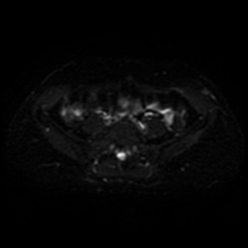 Cesarian section scar endometriosis (Radiopaedia 66520-75799 Axial DWI 1).jpg