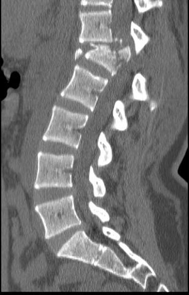 File:Chance fracture (Radiopaedia 11293-11657 Sagittal bone window 1).jpg