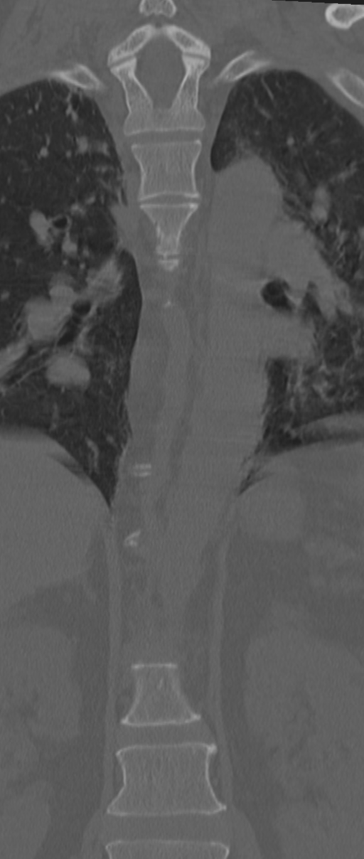 Chance fracture (Radiopaedia 33854-35020 Coronal bone window 35).png