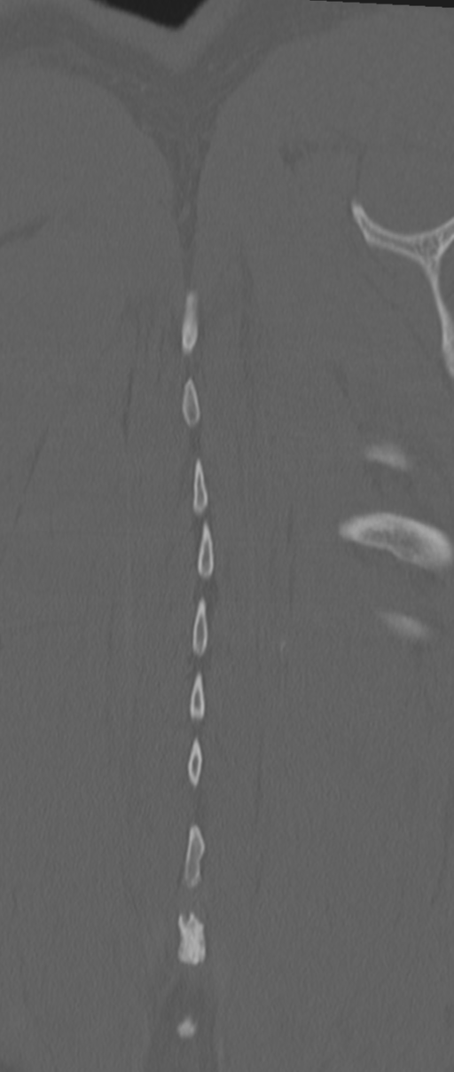 Chance fracture (Radiopaedia 33854-35020 Coronal bone window 80).png
